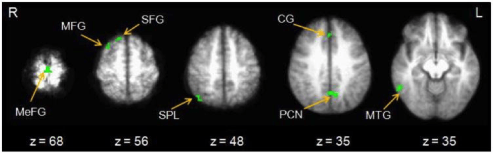 brain scans lighting up when being presented with immediate rewards/hyperbolic discounting