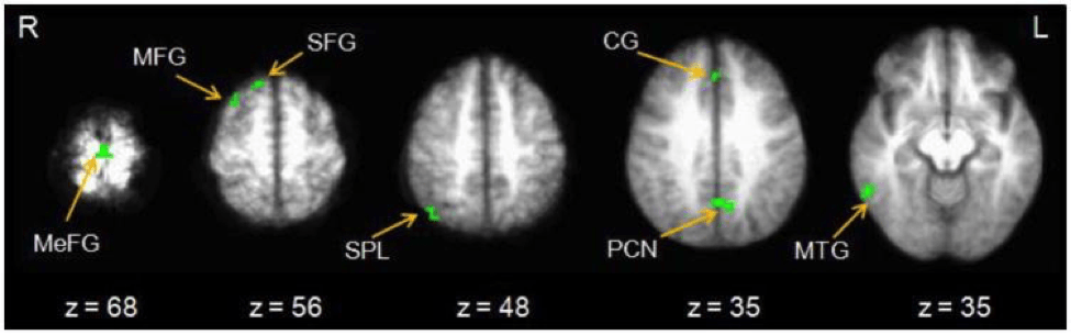 Brain scans light up when instant rewards / hyperbolic discounting are displayed